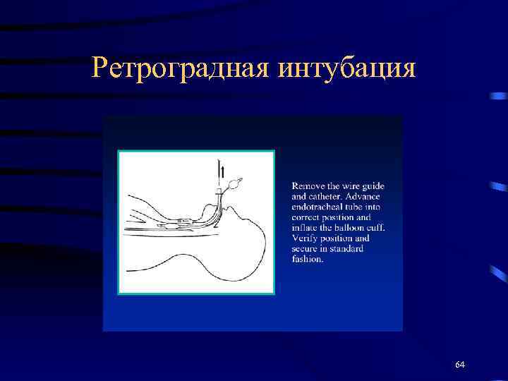 Ретроградная интубация 64 