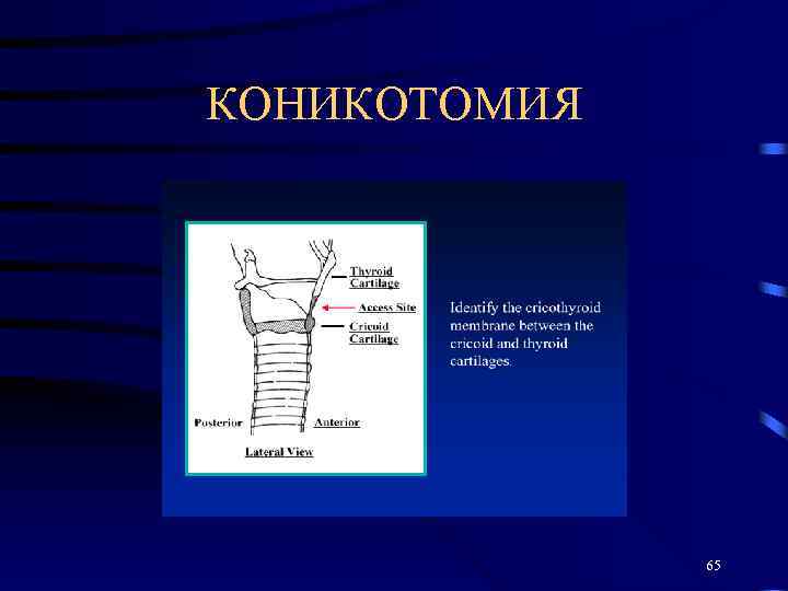 КОНИКОТОМИЯ 65 
