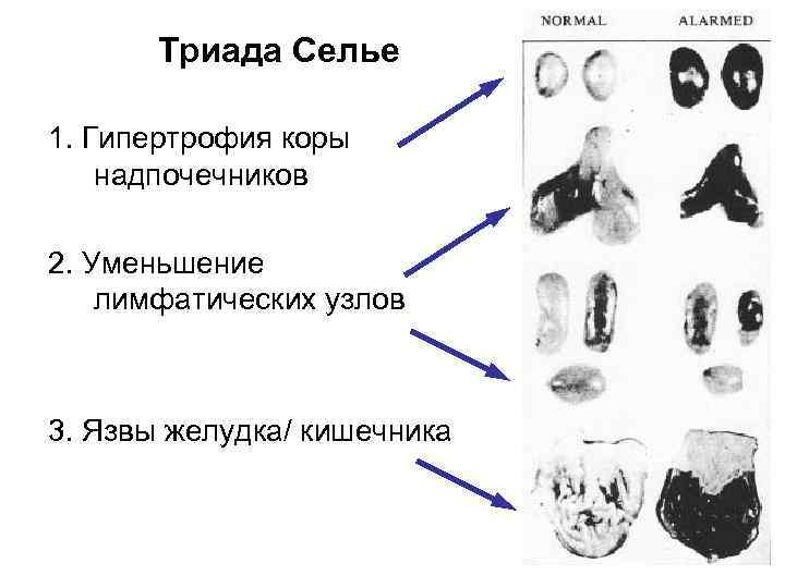 Триада Селье 1. Гипертрофия коры надпочечников 2. Уменьшение лимфатических узлов 3. Язвы желудка/ кишечника