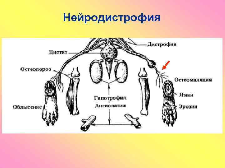 Нейродистрофия 