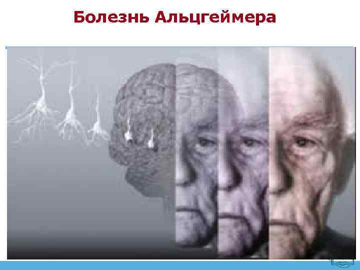 Болезнь Альцгеймера 1. Начало от 50 до 65 лет 2. Постепенное начало. волнообразное течение