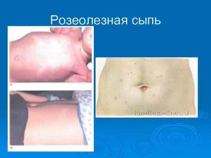 Розеолезная сыпь 