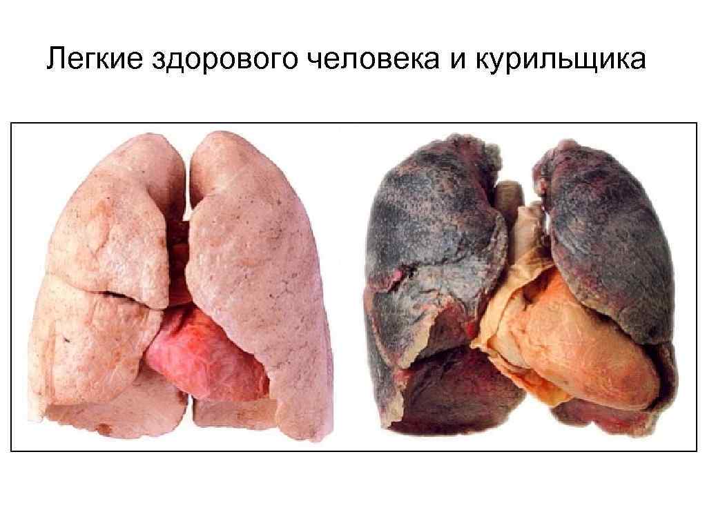 Легкие здорового человека и курильщика 
