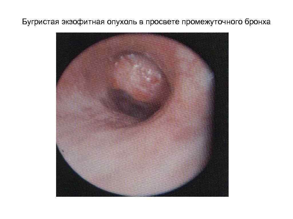 Бугристая экзофитная опухоль в просвете промежуточного бронха 