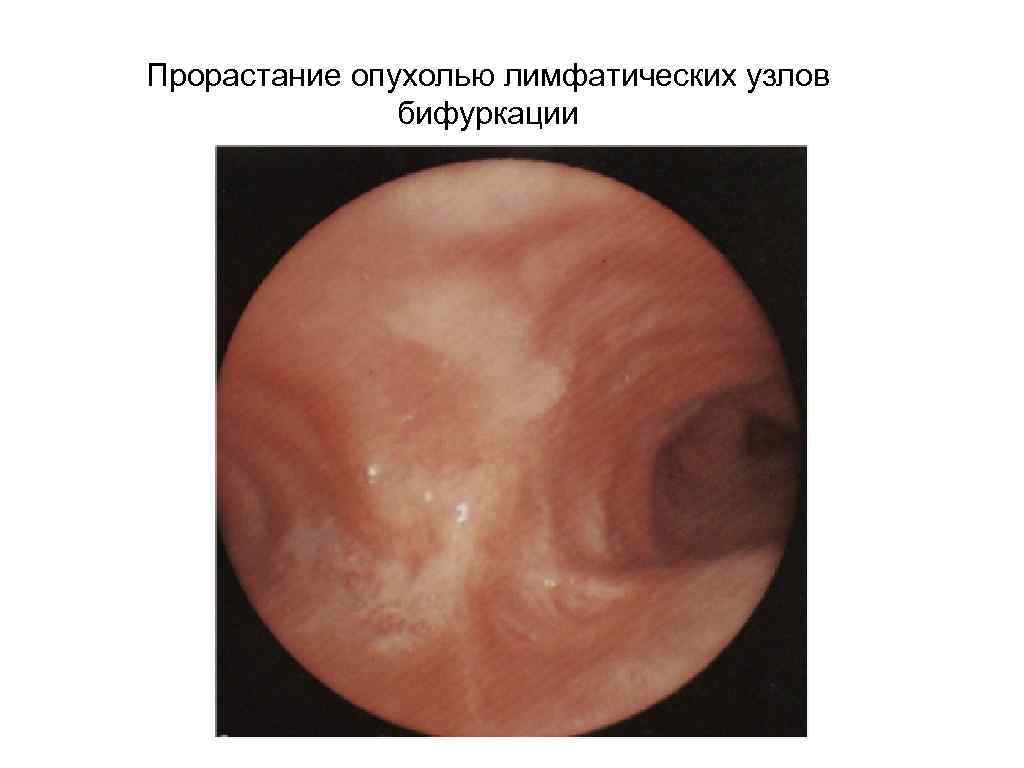 Прорастание опухолью лимфатических узлов бифуркации 
