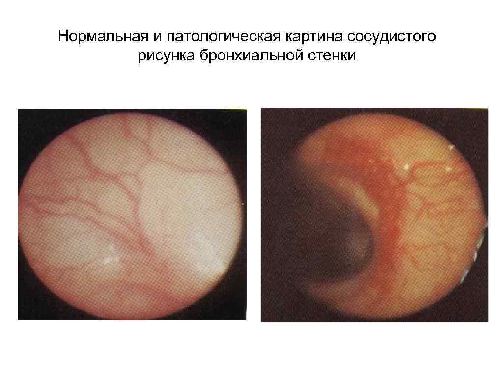 Нормальная и патологическая картина сосудистого рисунка бронхиальной стенки 