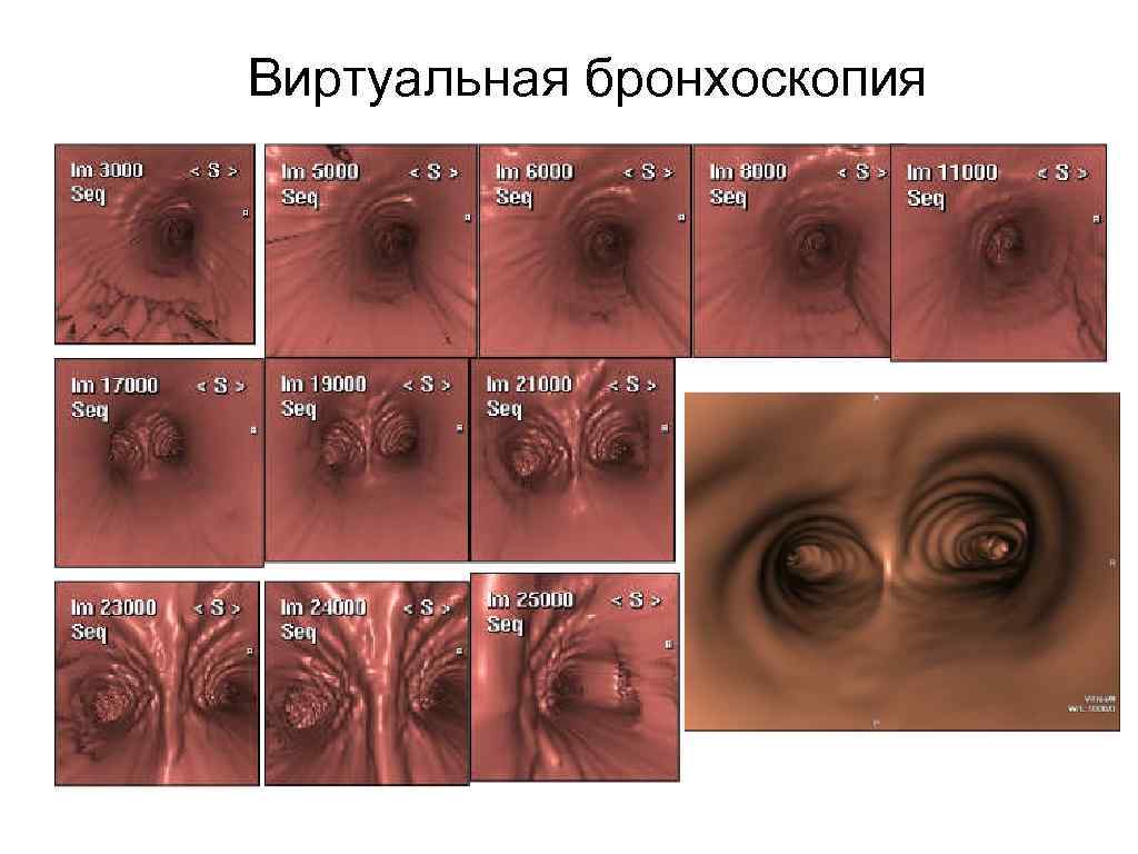 Виртуальная бронхоскопия 