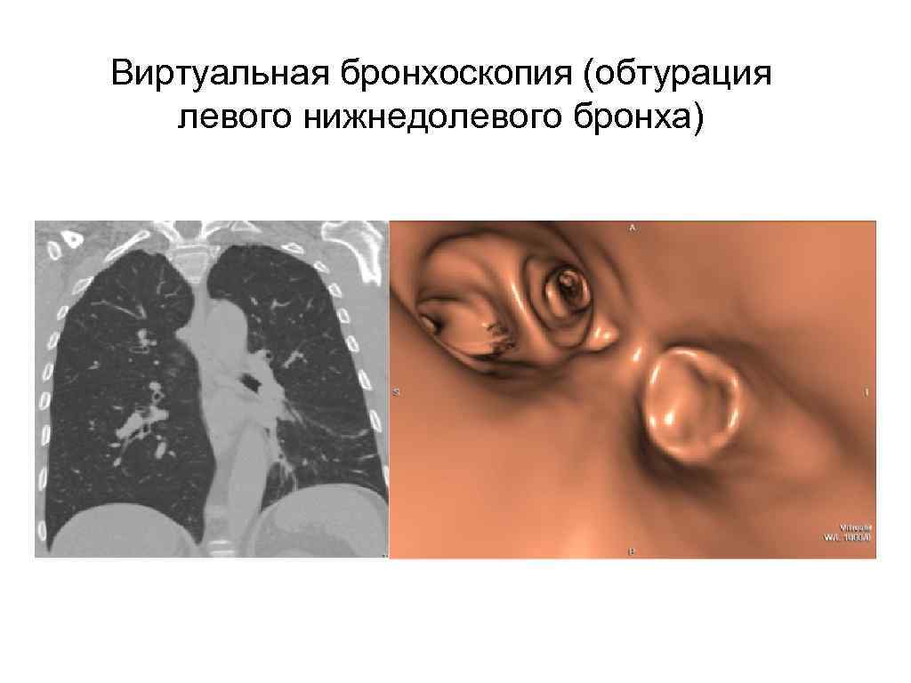 Виртуальная бронхоскопия (обтурация левого нижнедолевого бронха) 