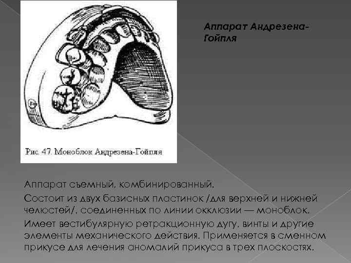 Аппарат Андрезена. Гойпля Аппарат съемный, комбинированный. Состоит из двух базисных пластинок /для верхней и