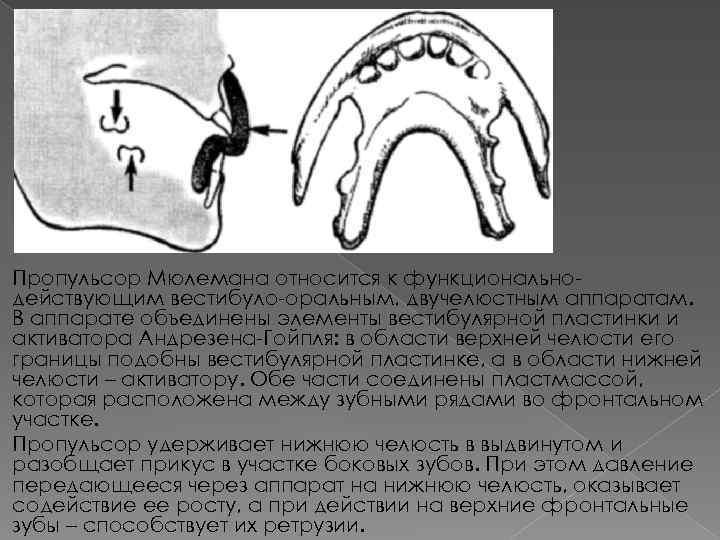 Пропульсор Мюлемана относится к функциональнодействующим вестибуло-оральным, двучелюстным аппаратам. В аппарате объединены элементы вестибулярной пластинки