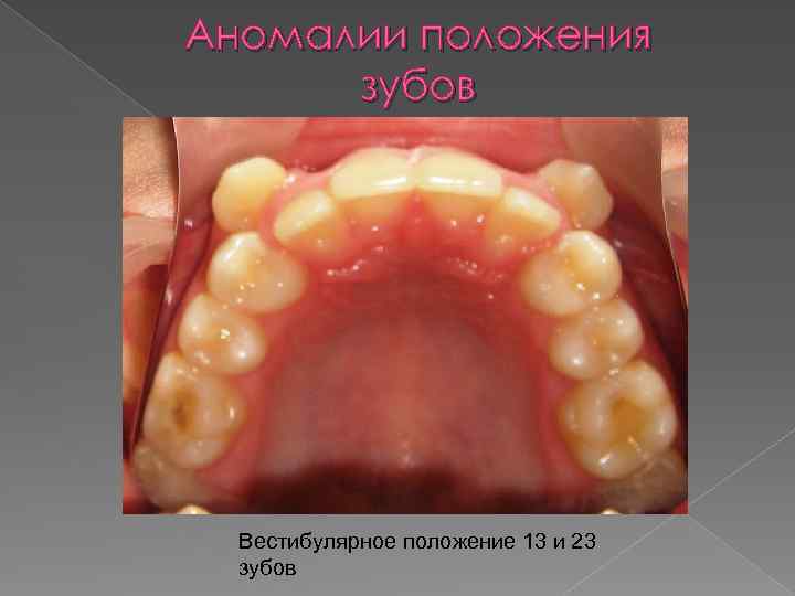 Аномалии положения зубов Вестибулярное положение 13 и 23 зубов 