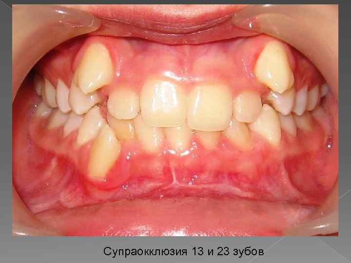 Супраокклюзия 13 и 23 зубов 