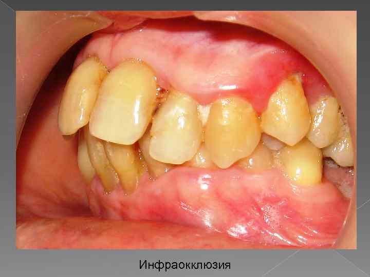 Инфраокклюзия 