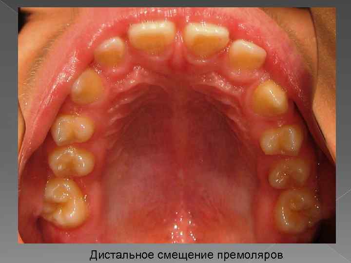 Дистальное смещение премоляров 