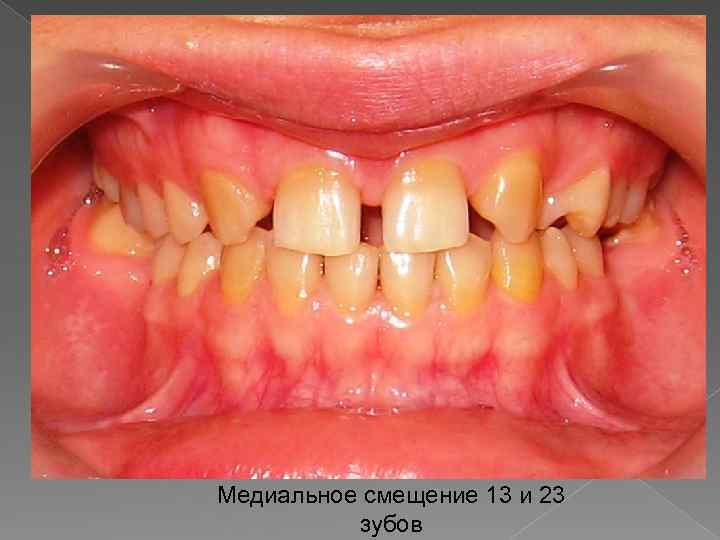Медиальное смещение 13 и 23 зубов 