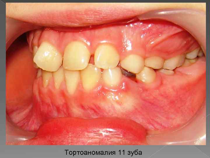 Тортоаномалия 11 зуба 