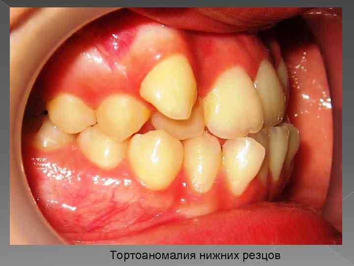 Тортоаномалия нижних резцов 