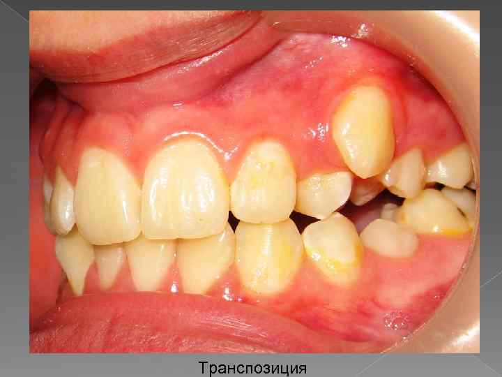 Транспозиция 