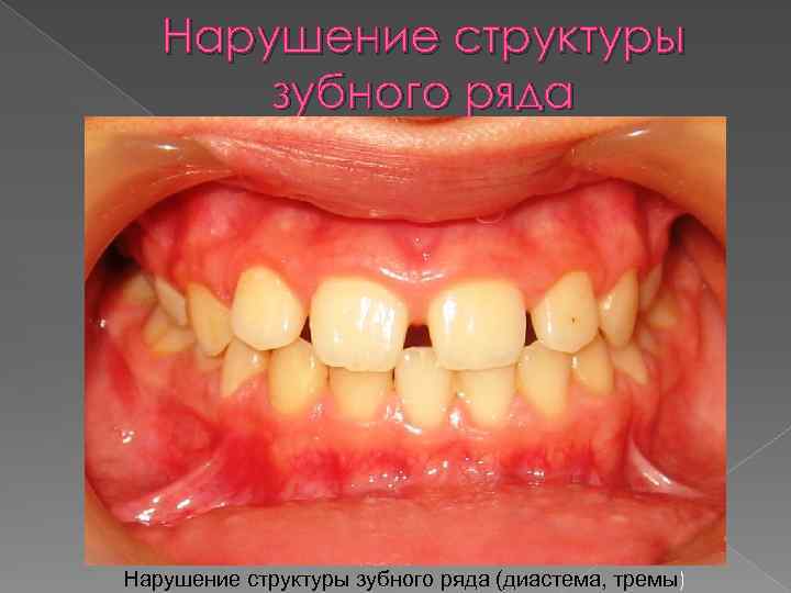 Нарушение структуры зубного ряда (диастема, тремы) 