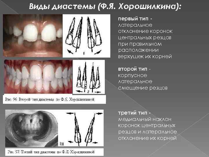 Этиология классификация клиническая картина диагностика и лечение различных форм дистальной окклюзии