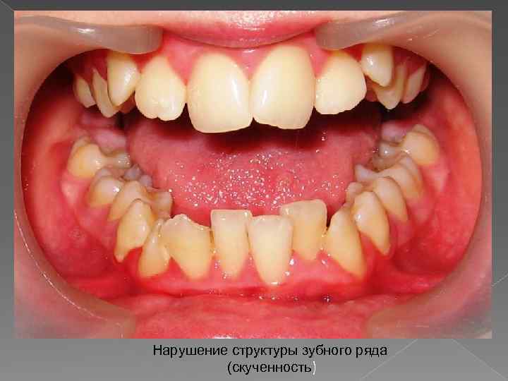 Нарушение структуры зубного ряда (скученность) 