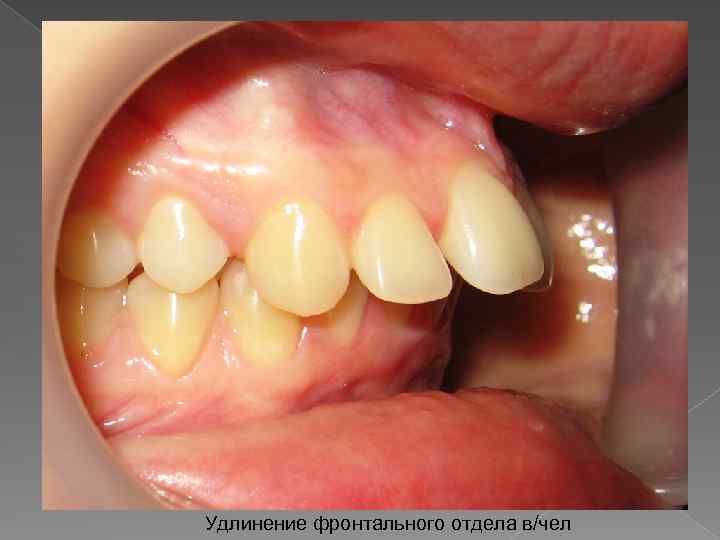 Удлинение фронтального отдела в/чел 
