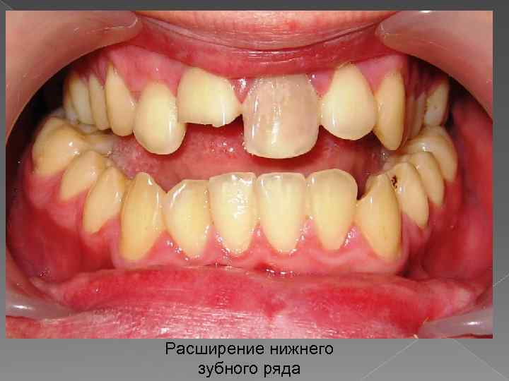 Расширение нижнего зубного ряда 