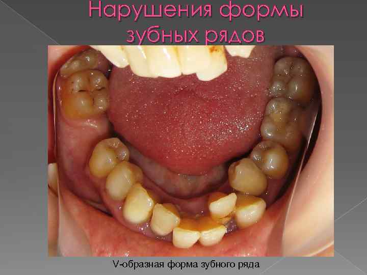 Нарушения формы зубных рядов V-образная форма зубного ряда 