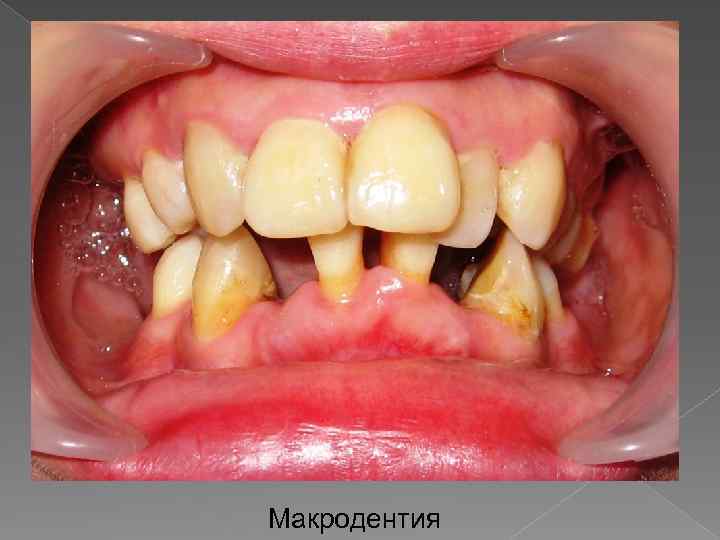 Макродентия 