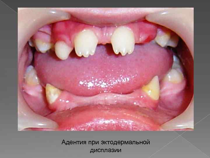 Адентия при эктодермальной дисплазии 