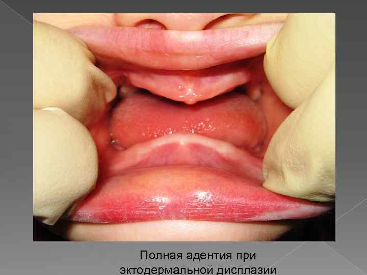 Полная адентия при эктодермальной дисплазии 