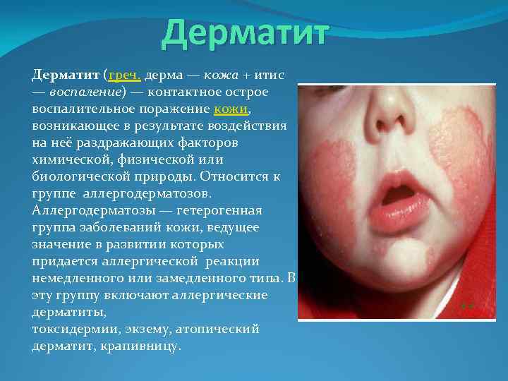 Дерматит (греч. дерма — кожа + итис — воспаление) — контактное острое воспалительное поражение
