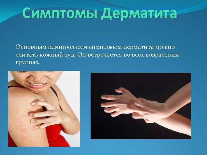 Симптомы Дерматита Основным клиническим симптомом дерматита можно считать кожный зуд. Он встречается во всех