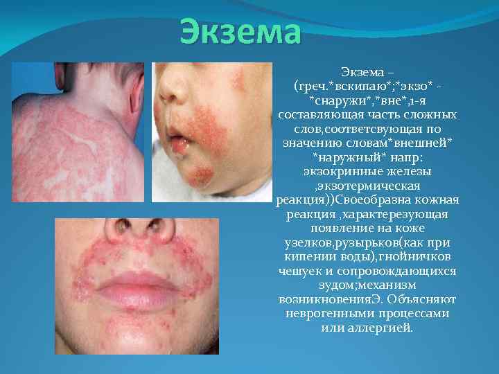 Экзема – (греч. *вскипаю*; *экзо* - *снаружи*, *вне*, 1 -я составляющая часть сложных слов,