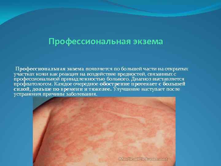 Профессиональная экзема появляется по большей части на открытых участках кожи как реакция на воздействие