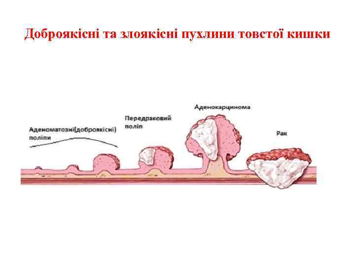 Доброякісні та злоякісні пухлини товстої кишки 