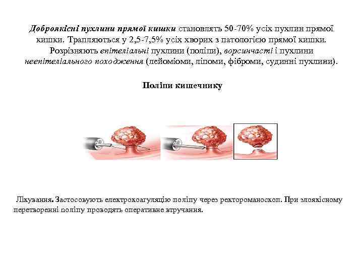 Доброякісні пухлини прямої кишки становлять 50 70% усіх пухлин прямої кишки. Трапляються у 2,