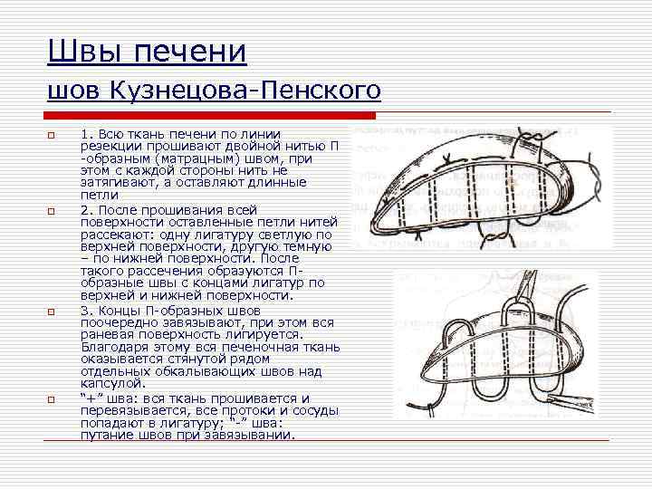 Швы печени шов Кузнецова-Пенского o o 1. Всю ткань печени по линии резекции прошивают