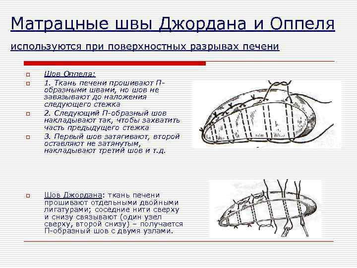 Матрацные швы Джордана и Оппеля используются при поверхностных разрывах печени o o o Шов