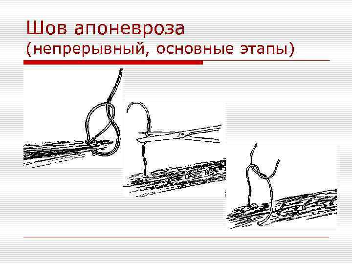 Шов апоневроза (непрерывный, основные этапы) 