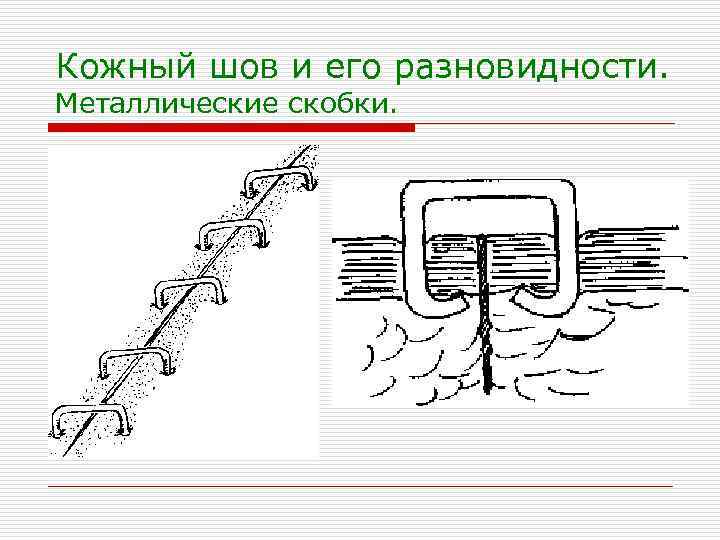 Кожный шов и его разновидности. Металлические скобки. 