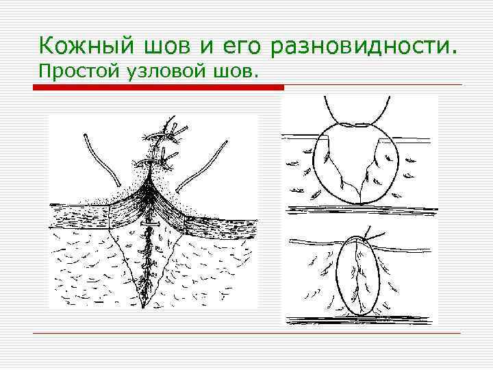 Кожный шов и его разновидности. Простой узловой шов. 