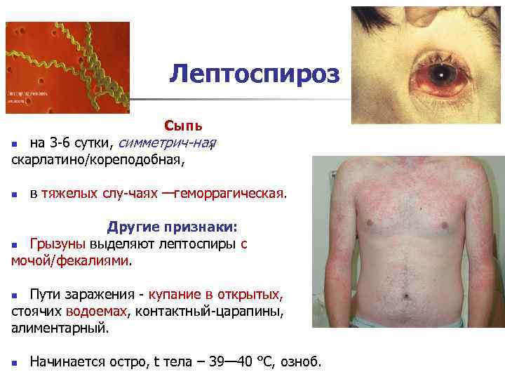 Лептоспироз Сыпь на 3 6 сутки, симметрич ная , скарлатино/кореподобная, n n в тяжелых