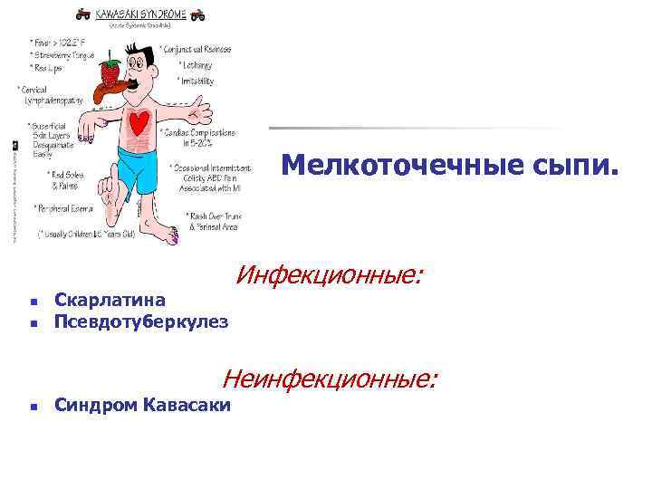 Мелкоточечные сыпи. n n Скарлатина Псевдотуберкулез Инфекционные: Неинфекционные: n Синдром Кавасаки 