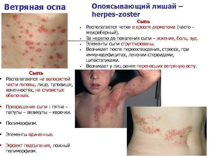 Ветряная оспа Опоясывающий лишай – herpes-zoster § § § Сыпь § Располагаются на волосистой