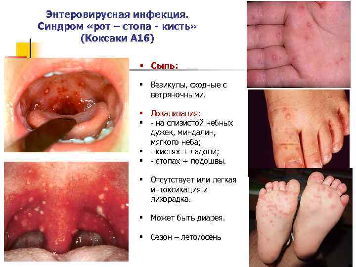 Энтеровирусная инфекция. Синдром «рот – стопа - кисть» (Коксаки А 16) § Сыпь: §