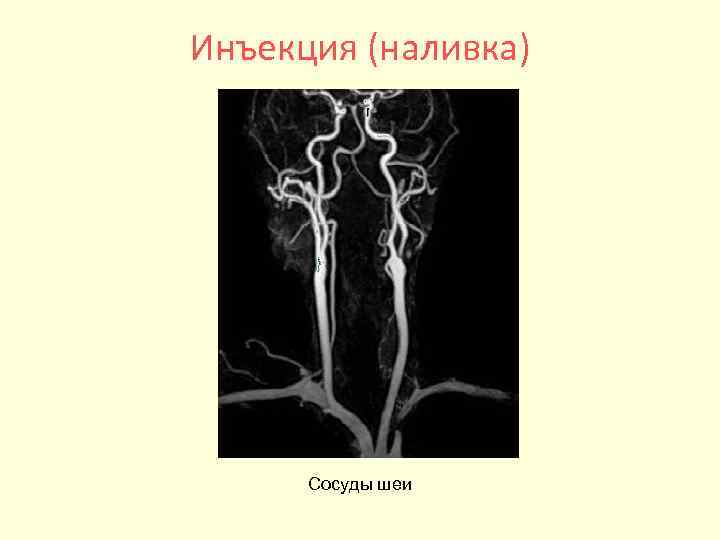 Инъекция (наливка) Сосуды шеи 