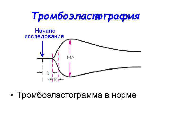 Тромбоэластография • Тромбоэластограмма в норме 