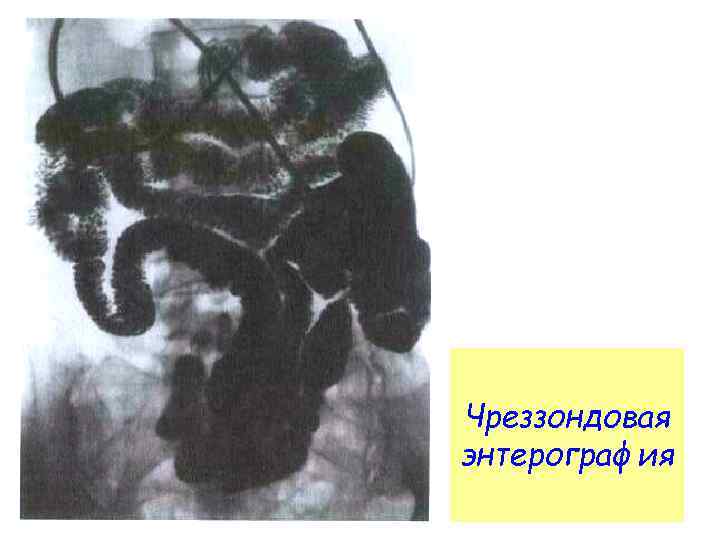 Чреззондовая энтерография 