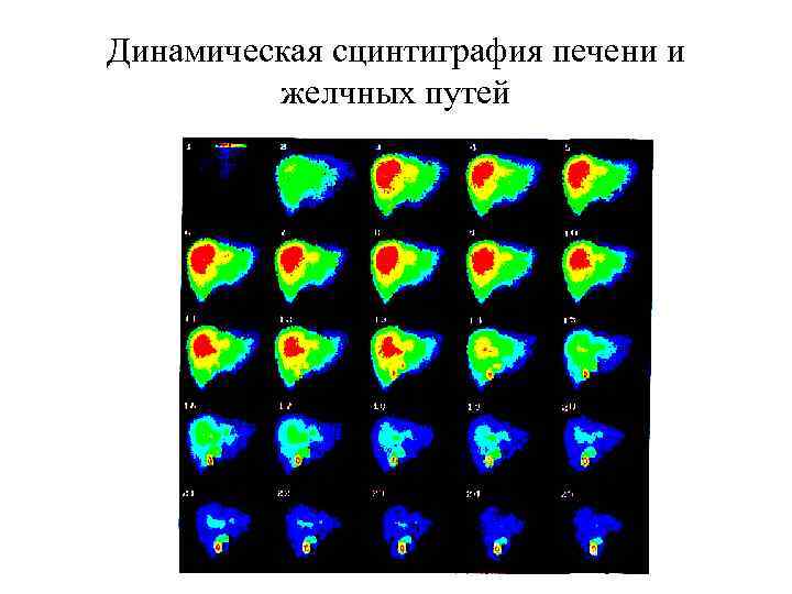 Динамическая сцинтиграфия печени и желчных путей 